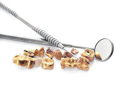 Denti d'oro: Valutazione e acquisto di lega dentale